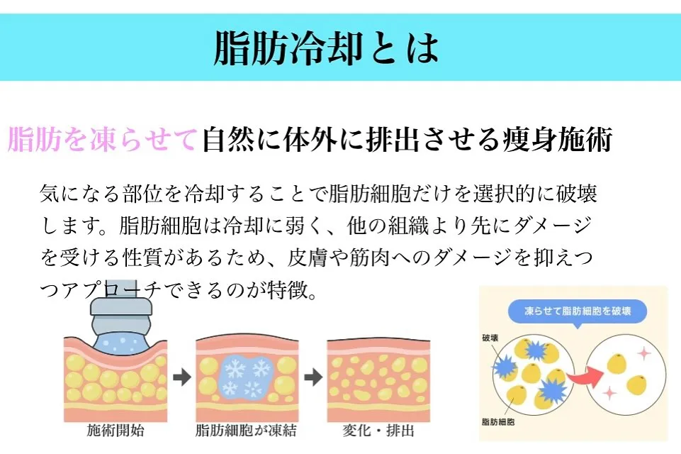 脂肪冷却とは何か？